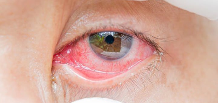 causas lagrimeo en los ojos conjuntivitis