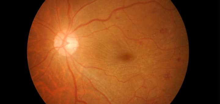 Ojo afectado por la retinopatía diabética.