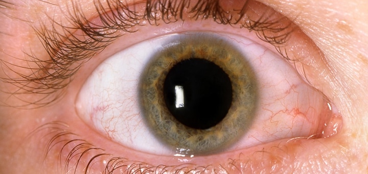 BLOG » retinopatia diabetica