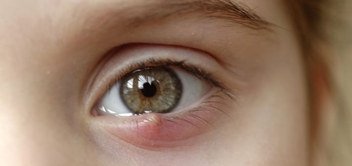 Chalazión en el ojo: qué es, causas y tratamiento » chalazión