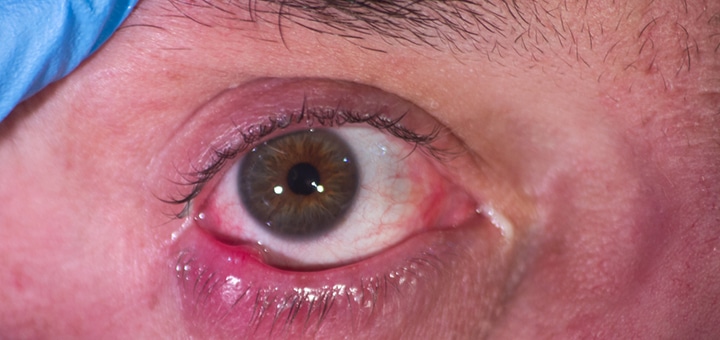 Ojos con un orzuelo en el borde inferior.