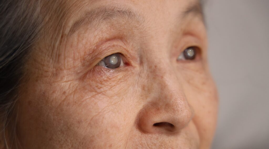 Cataratas en los Ojos: ¿Qué son?, Síntomas y Tratamiento