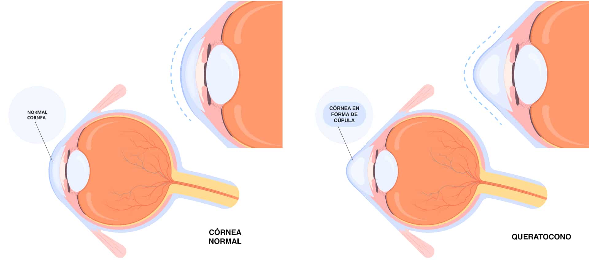 El crosslinking corneal evita la rápida progresión de enfermedades como el queratocono.