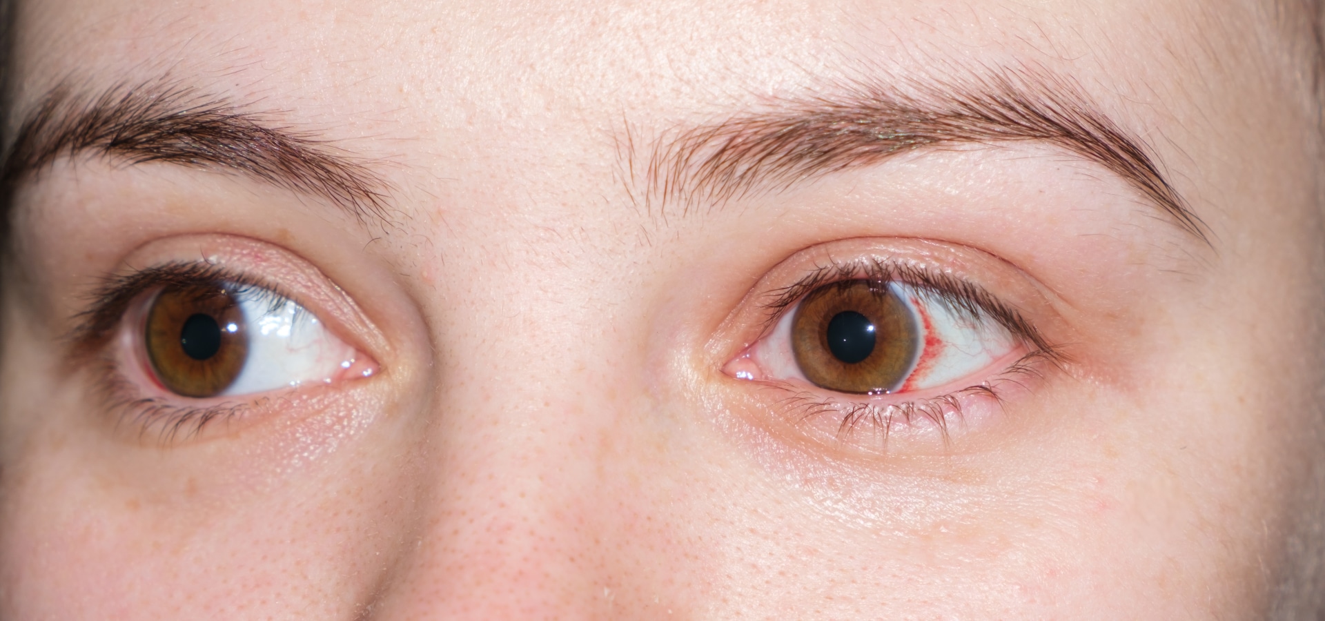 Aprende todo sobre la hipertensión oculary cómo prevenirla.