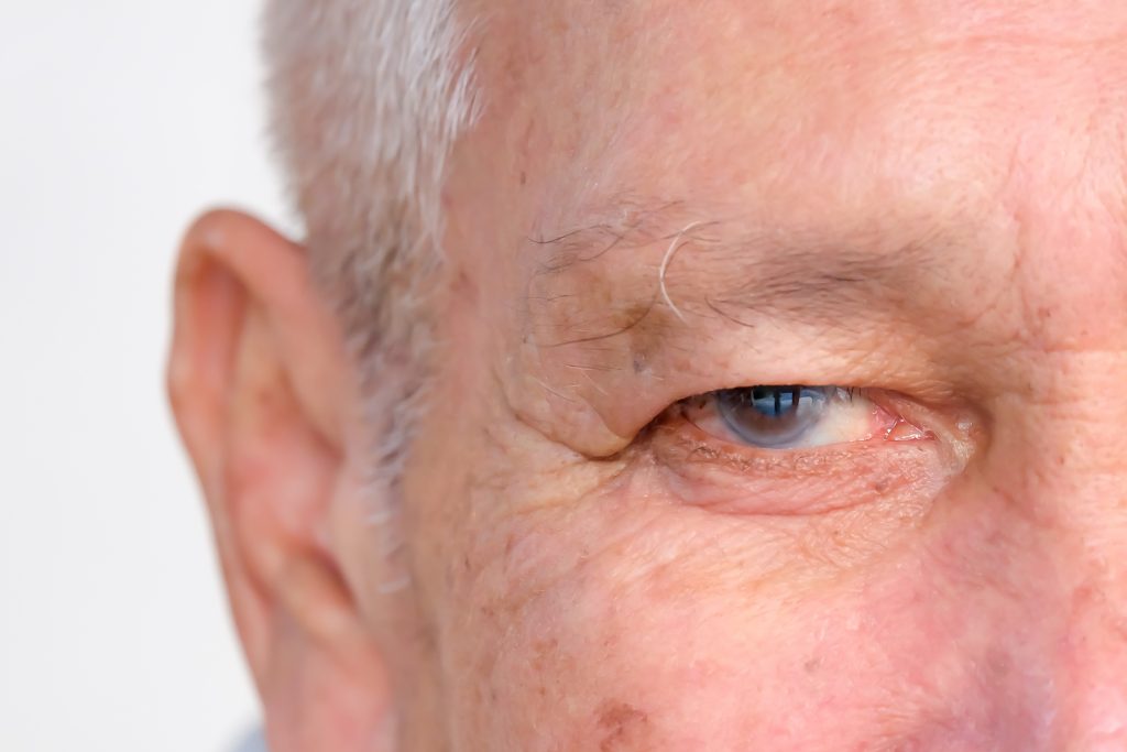 Glaucoma sintomas