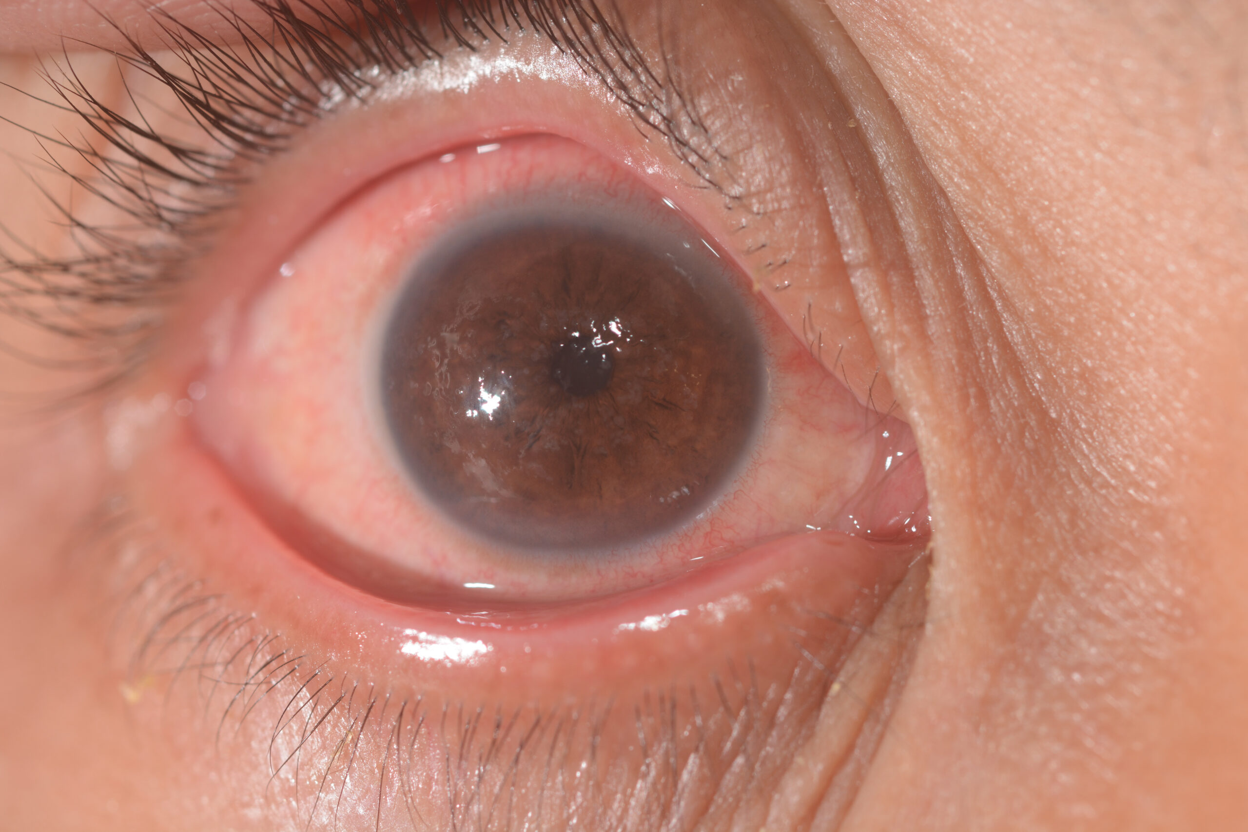 Edema corneal