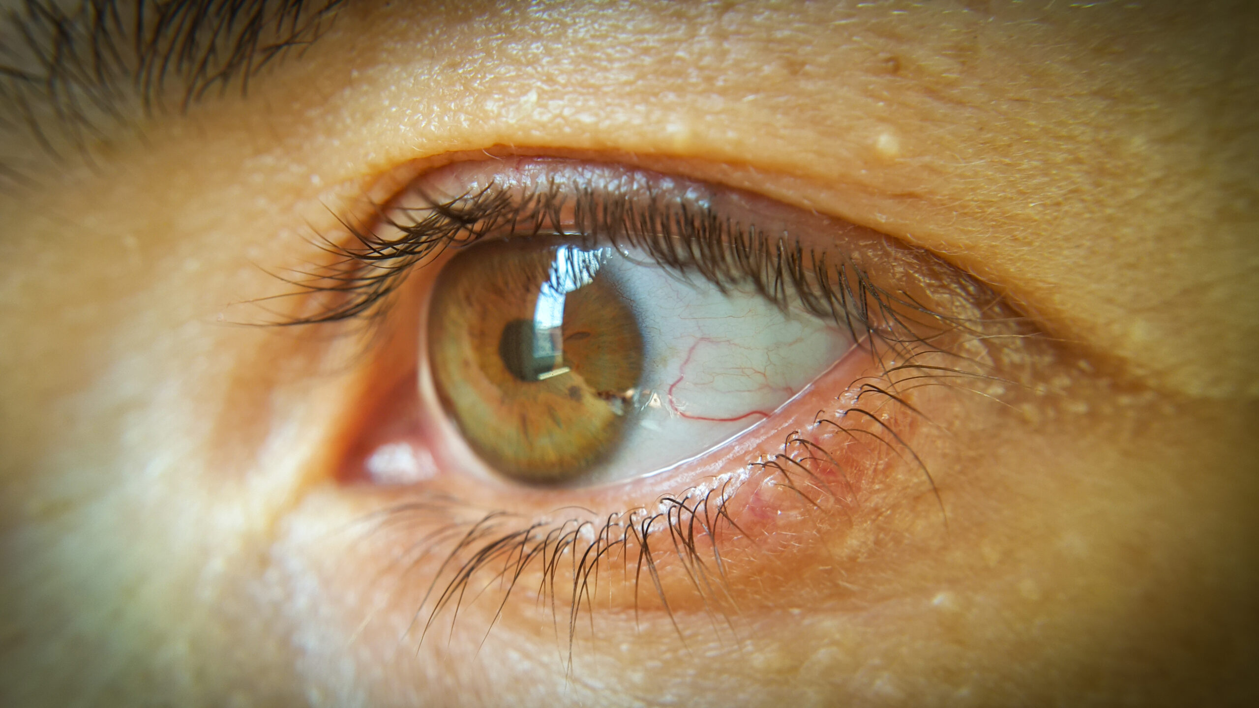 Presión intraocular alta
