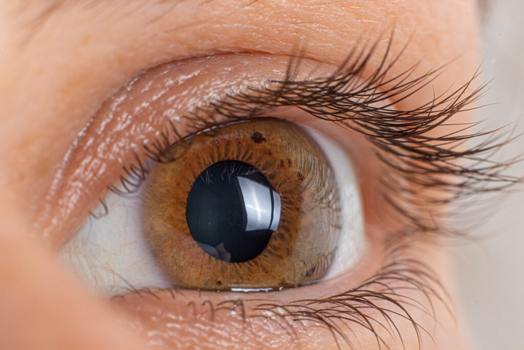 Distrofia corneal