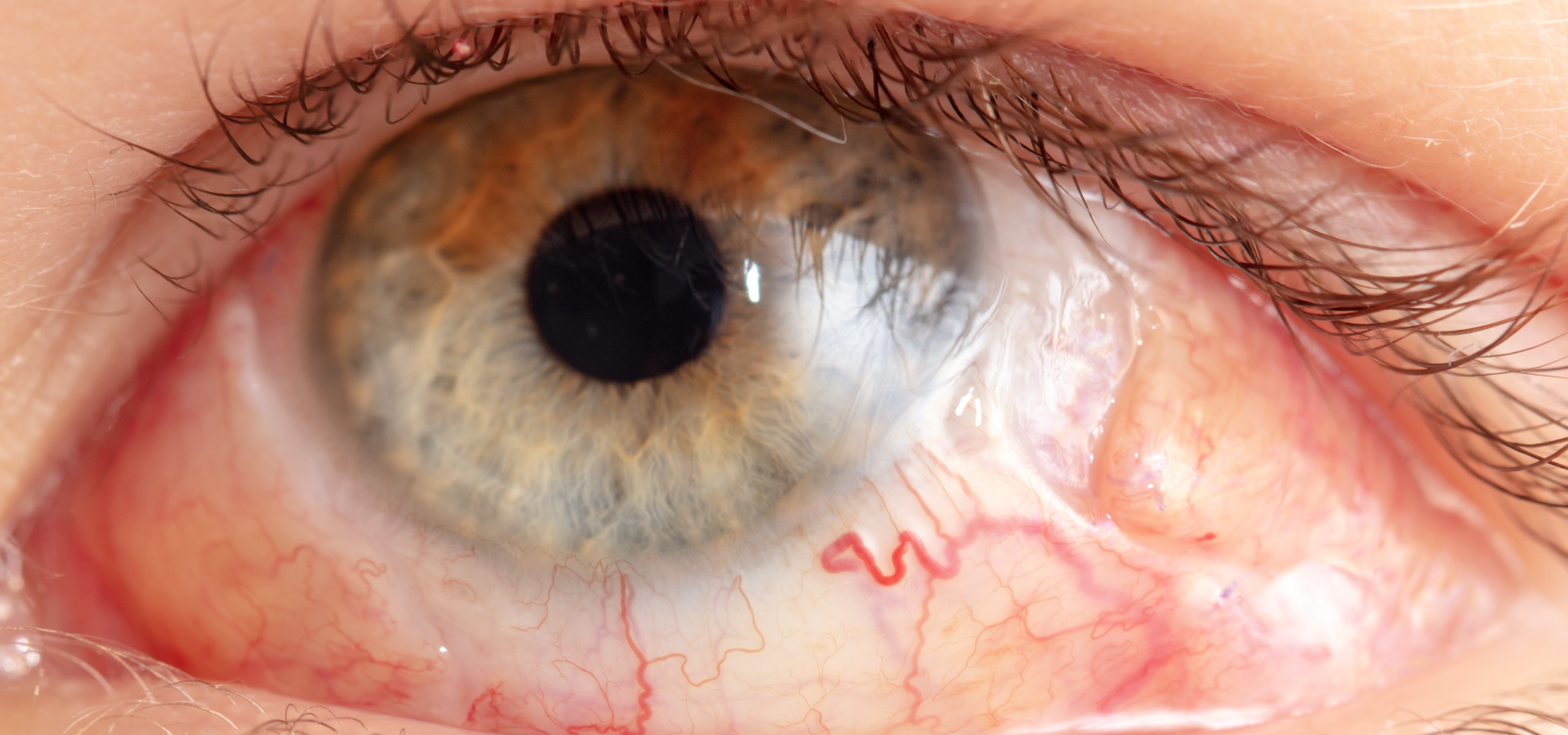 Conoce todo sobre el desprendimiento de retina.