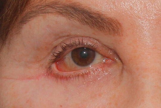 ectropion