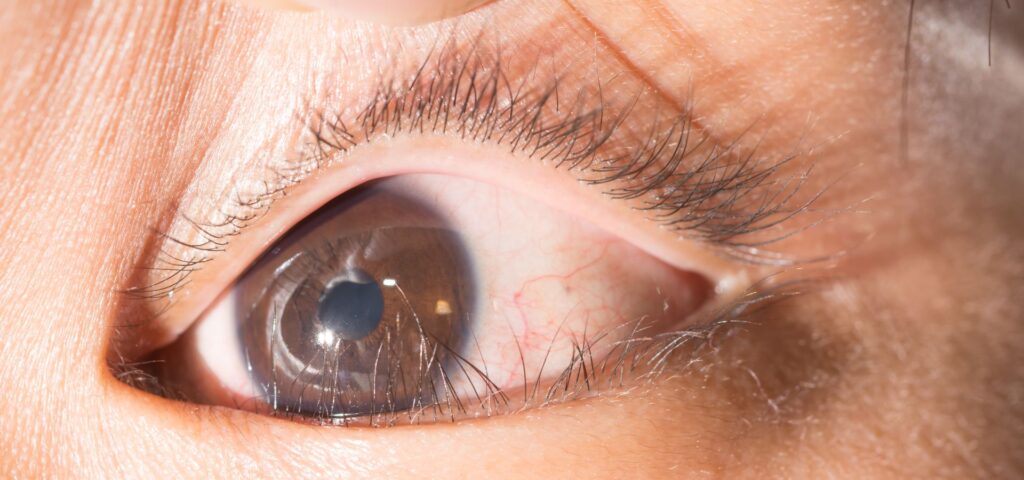 En este artículo aprenderemos sobre el epiblefaron: en qué consiste, por qué ocurre, los síntomas que genera, cómo diagnosticarlo y los posibles tratamientos.