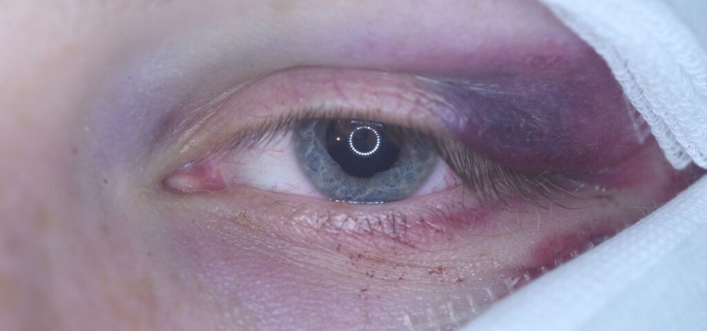 En este artículo aprenderemos sobre el tipo de glaucoma traumático: en qué consiste, por qué ocurre, los síntomas que presenta y los tratamientos disponibles para esta condición.