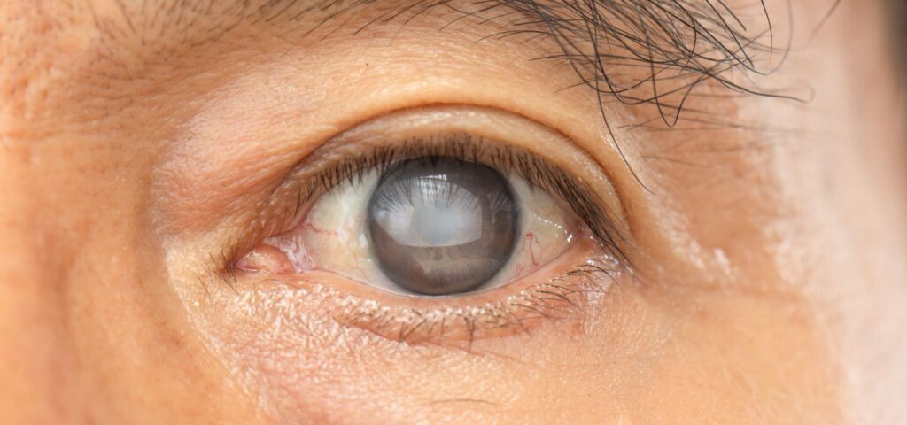 Este artículo conoceremos sobre la catarata nuclear: qué es, por qué se caracteriza, sus síntomas, causas y factores de riesgo, así como sus posibles tratamientos.