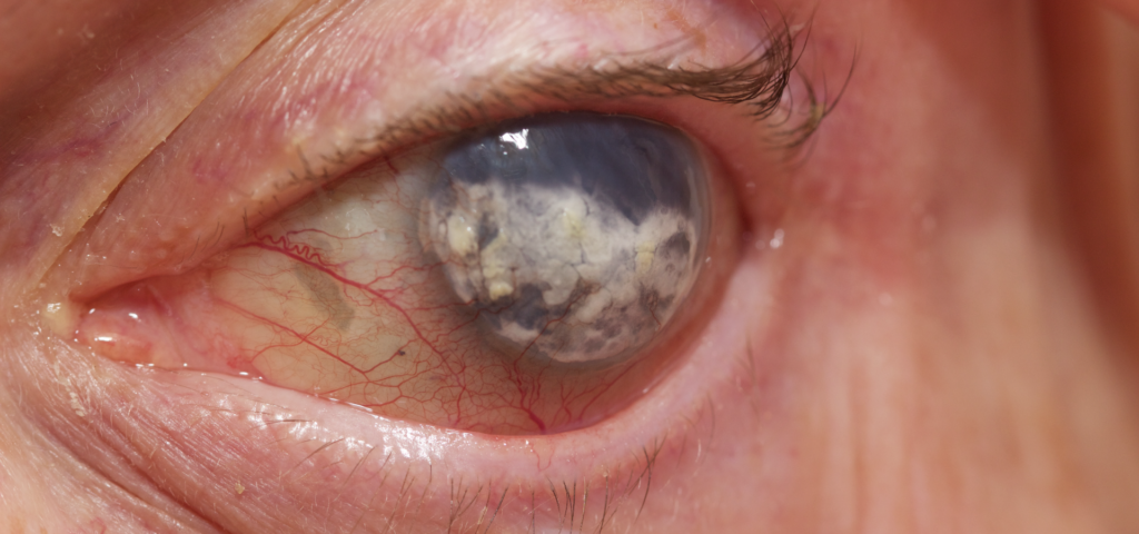 Conoce todo sobre la queratopatía y sus síntomas.