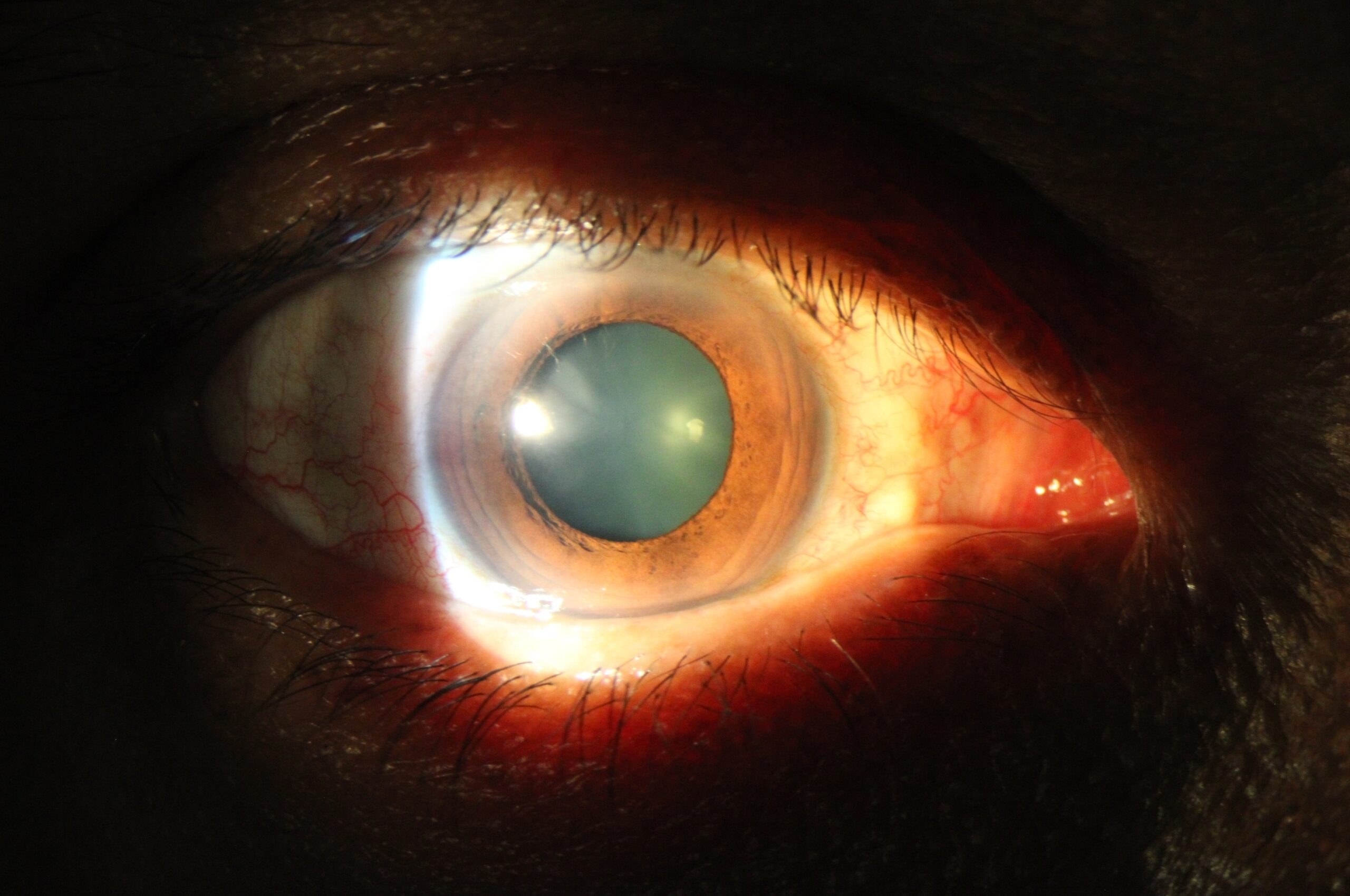 Reflejo corneal: ¿Qué es? y como es su evaluación