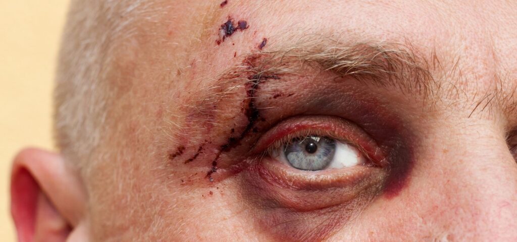 Conoce las lesiones oculares más comunes: cómo reconocer sus síntomas, las causas más frecuentes y cómo actuar ante una lesión.