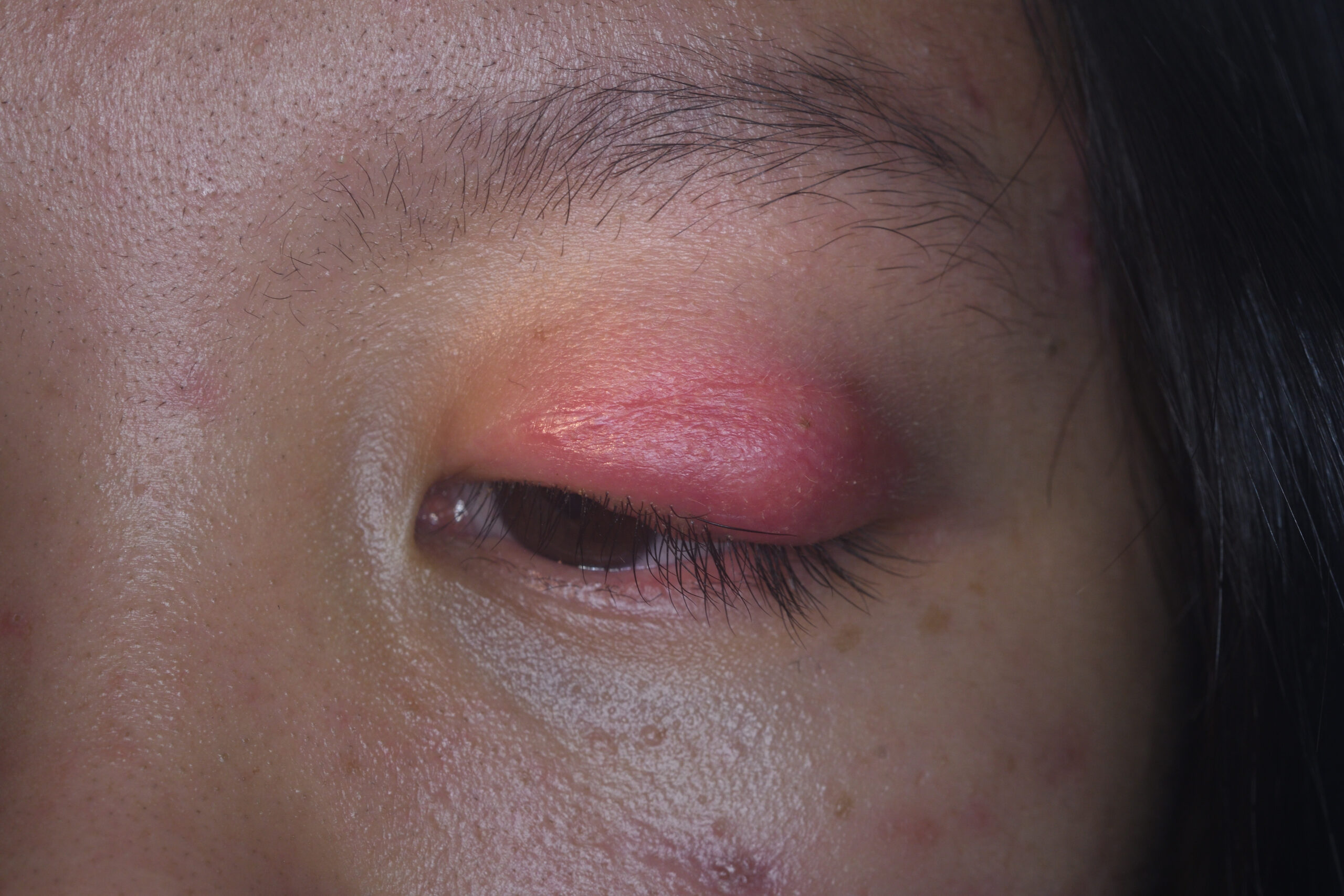 celulitis orbitaria