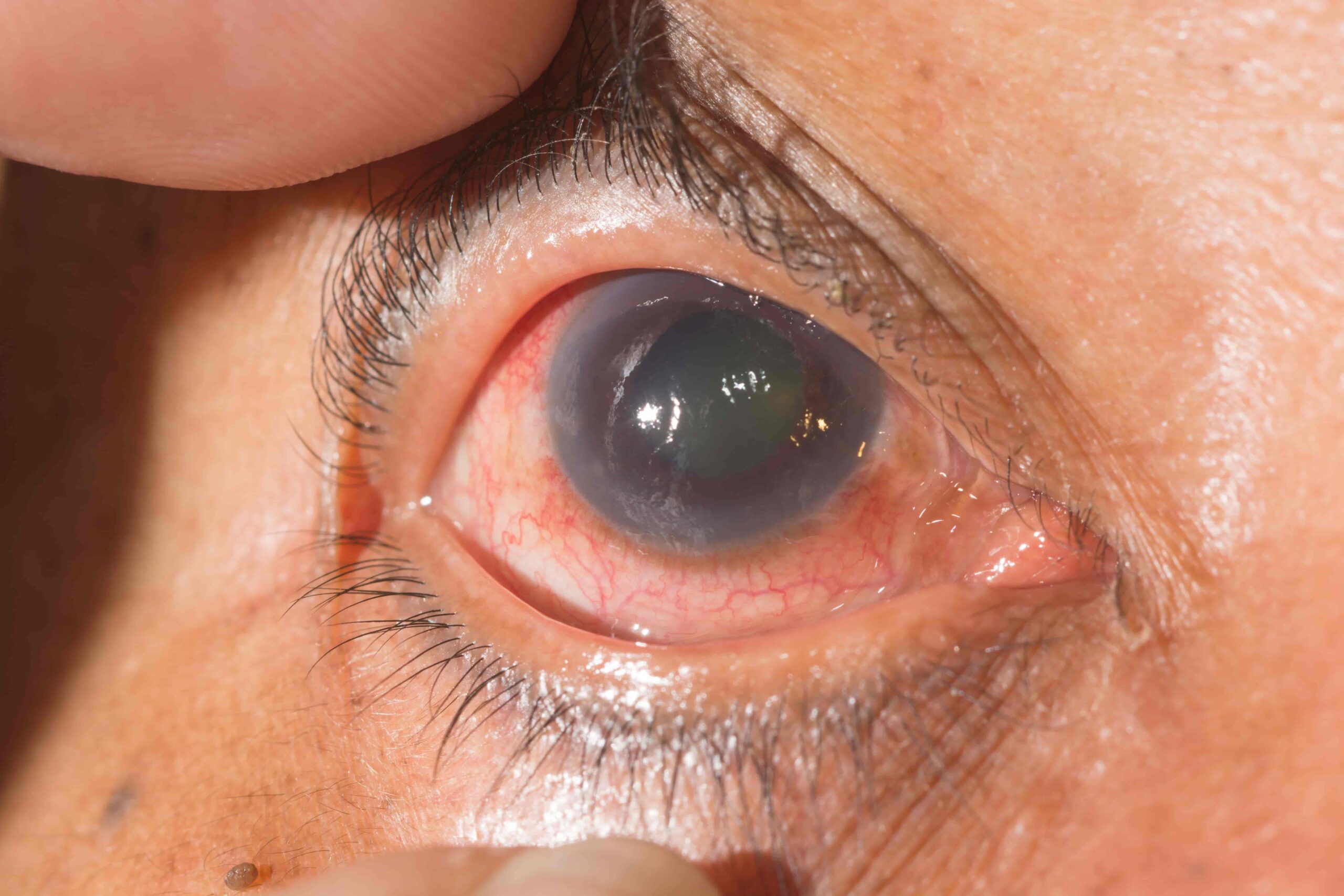 Glaucoma y diabetes: Conoce cómo afectan a tus ojos