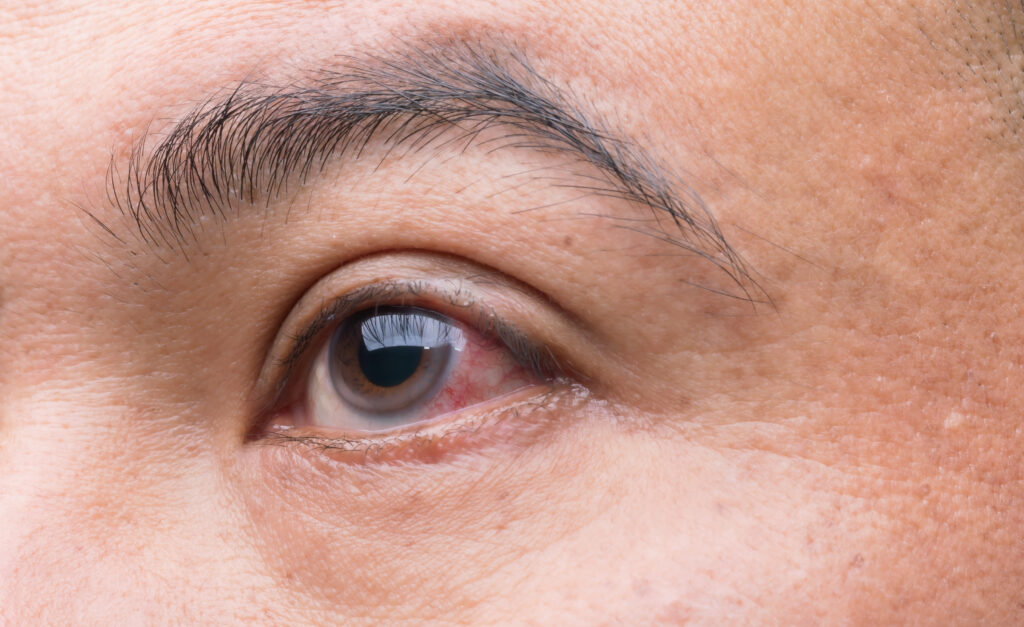 10 cosas que no debes hacer si tienes glaucoma