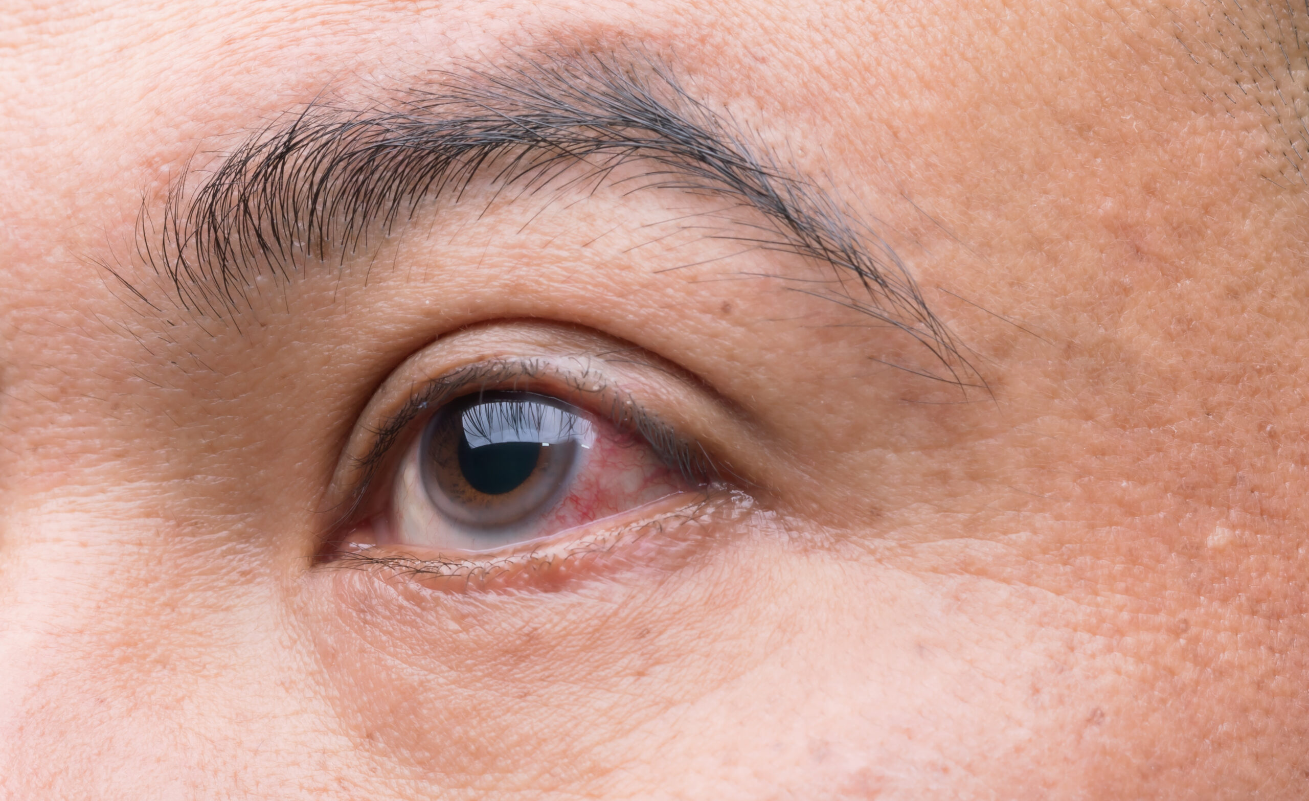 10 cosas que no debes hacer si tienes glaucoma