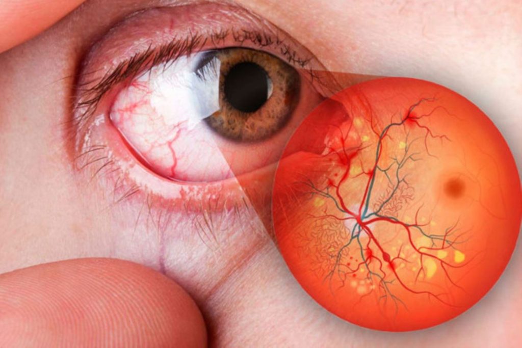 Retinopatía hipertensiva: causas, síntomas y etapas