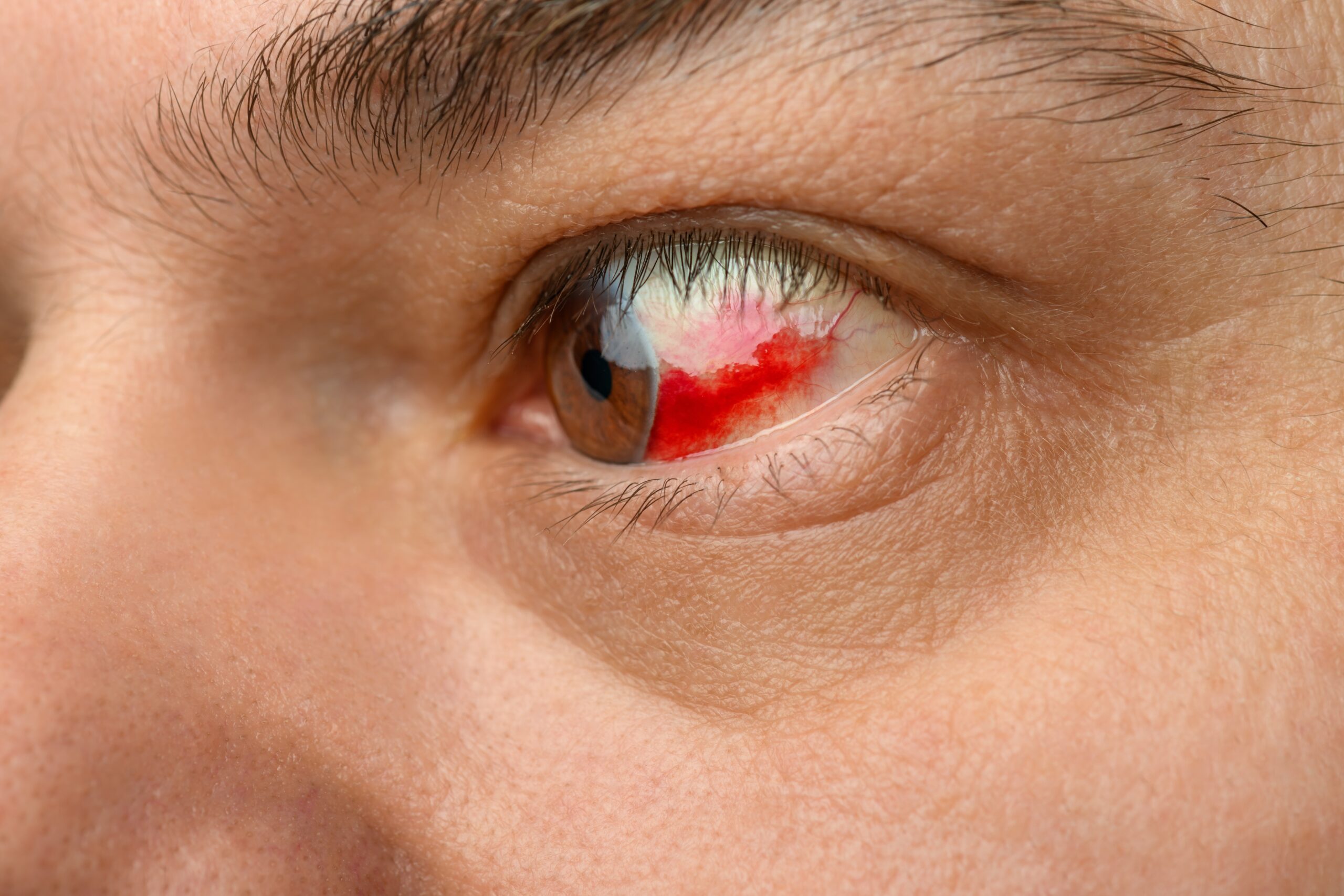 Derrame ocular