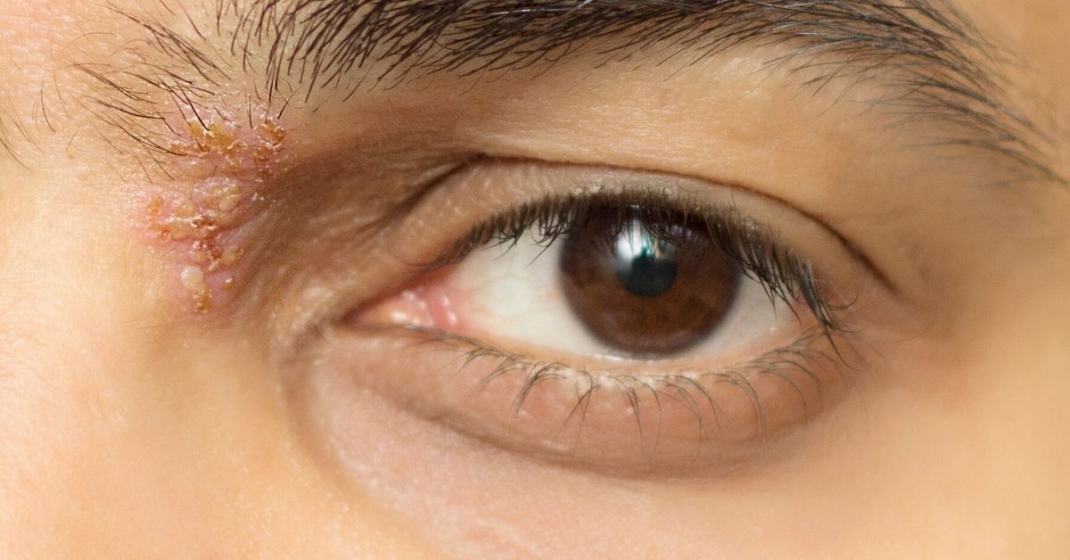 Herpes zoster oftálmico : Causas, diagnóstico y tratamiento