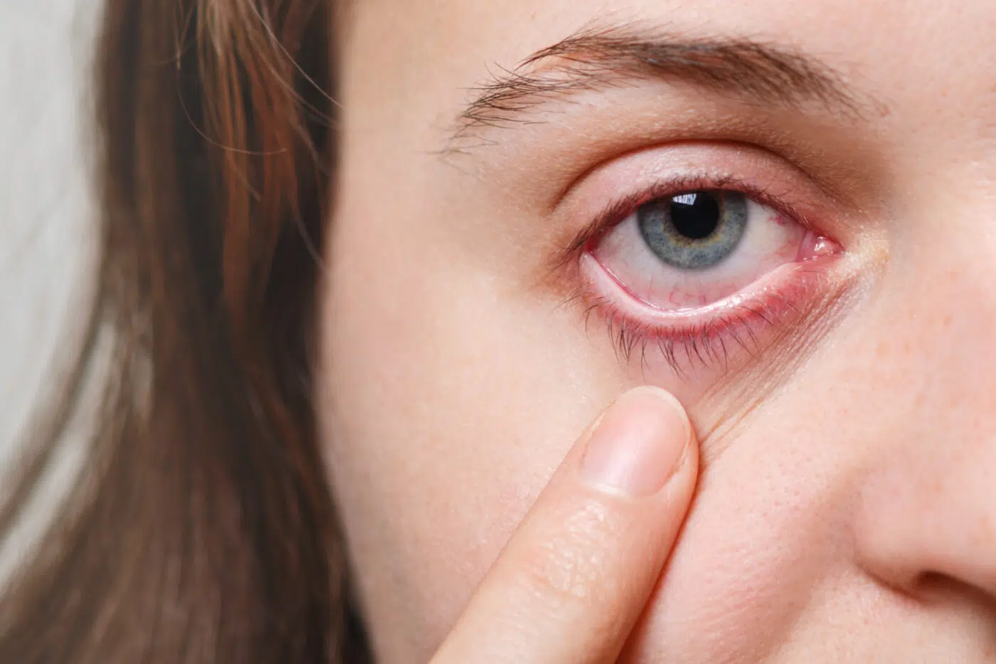 Infección por lentes de contacto: las señales que no debes ignorar
