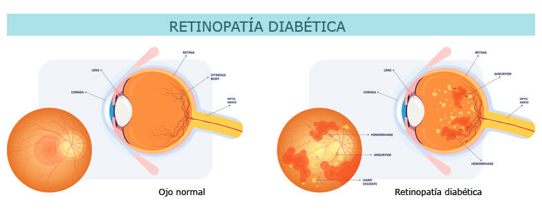 retinopatia diabetica